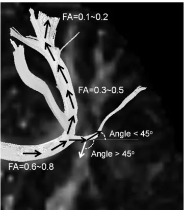 Fig. 3. Principle of streamline fiber tracking.  From starting point,  automatic 3-D fiber tracking is done by connecting voxel to voxel  with pre-defined threshold values of fractional anisotropy (FA) and  trajectory angle