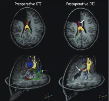 Fig. 10. 14-year-old male with intractable seizure and previous  right frontal lobectomy status