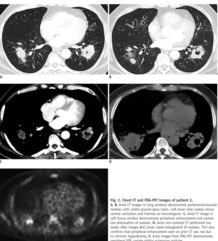 Fig. 2. Chest CT and FDG-PET images of patient 2. 
