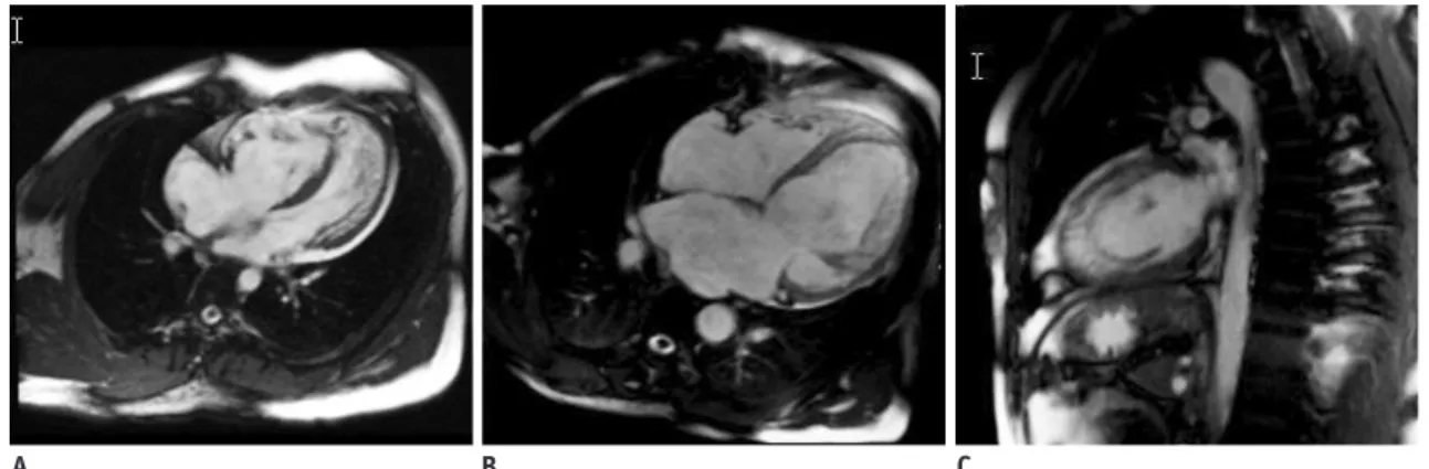 Fig. 3. Steady-state free precession sequence at end of  diastolic showing dilated left ventricle and ventricular  aneurysm in left ventricular apex (A), septal segment is not  affected in short-axis view of left ventricle (B).