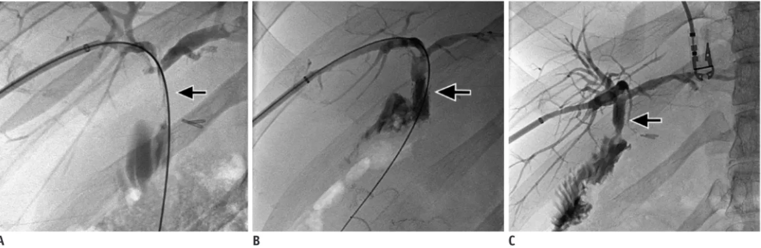 Fig. 1. Stent graft in postsurgical benign biliary stricture. 