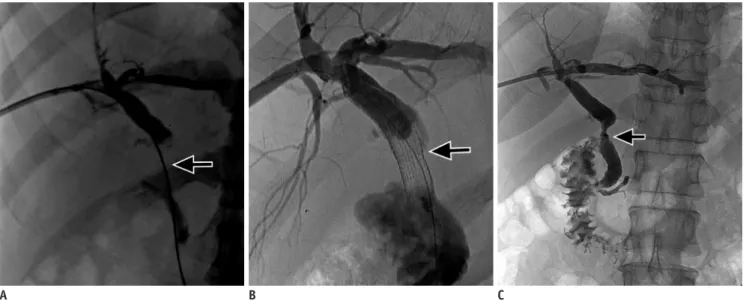 Fig. 2. Stent graft in postsurgical benign biliary stricture.