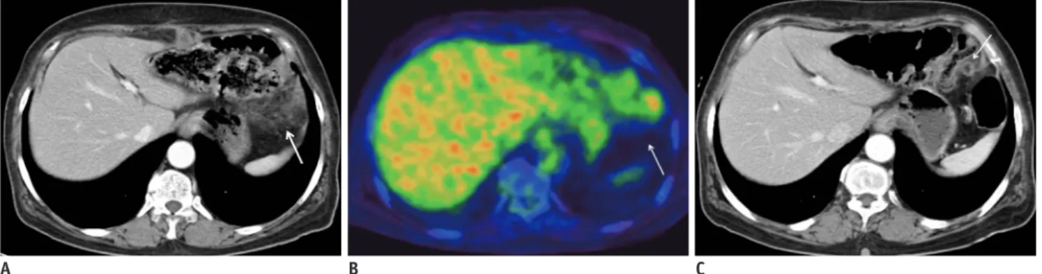 Fig. 1. Omental infarction after open distal gastrectomy.