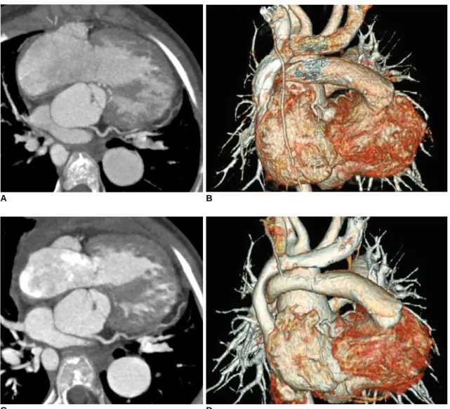 Fig. 11. Dose reduction by applying low kV and ECG-controlled tube current modulation to retrospective ECG-gated spiral CT scan in 9- 9-year-old girl with pulmonary atresia, ventricular septal defect and major aortopulmonary collateral arteries and who und