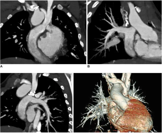 Fig. 12. Non-ECG-synchronized multiplanar reformatted (A-C) and volume-rendered (D) CT images clearly show patent Fontan pathway and pulmonary vessels in 5-year-old boy with functional single ventricle