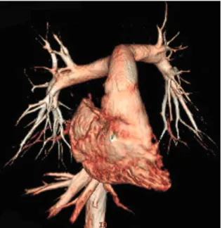 Fig. 1. Volume-rendered CT image with non-ECG-synchronized spiral scan shows excellent anatomic details of pulmonary arteries in 12-year-old girl with repaired coarctation of aorta.