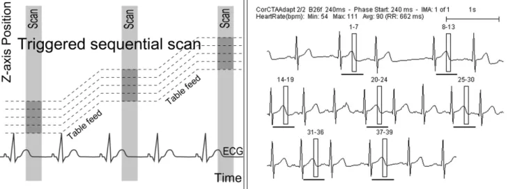 Fig. 5. Diagrams showing prospective ECG-triggered sequential CT scan.
