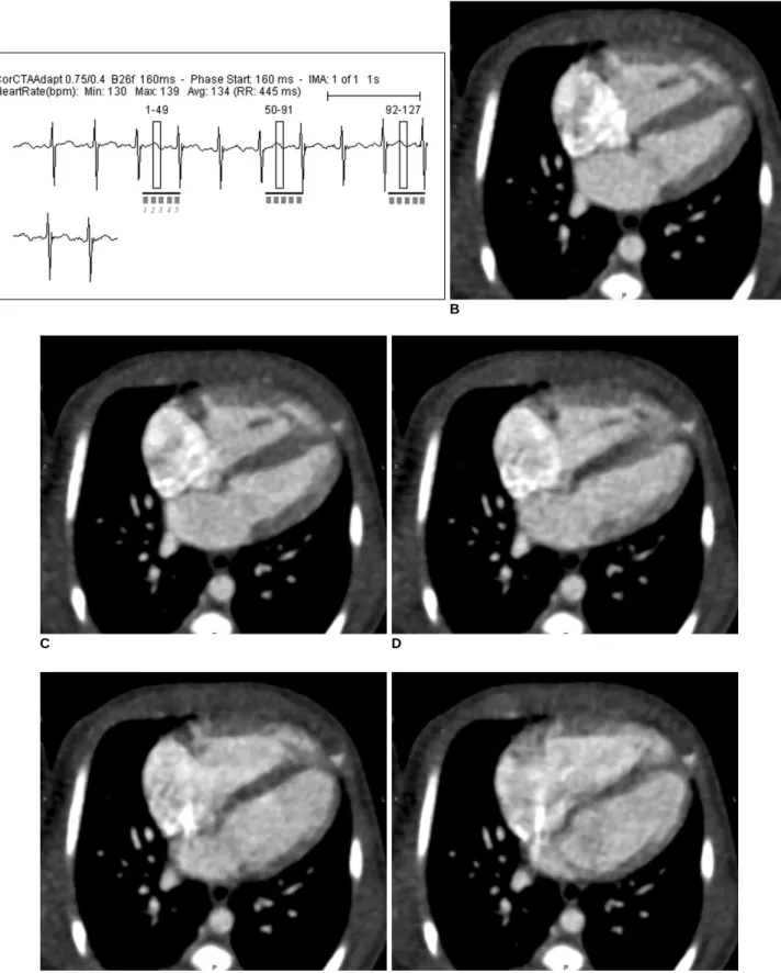 Fig. 6. Multi-phase prospective ECG-triggered sequential CT scan.
