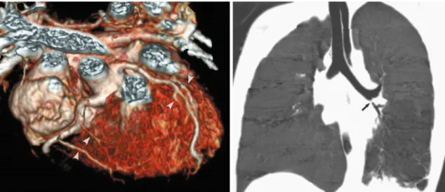 Fig. 7. Prospective ECG-triggered sequential CT scan in free-breathing young children is relatively less susceptible to respiratory motion artifacts than is retrospectively ECG-gated spiral CT scan