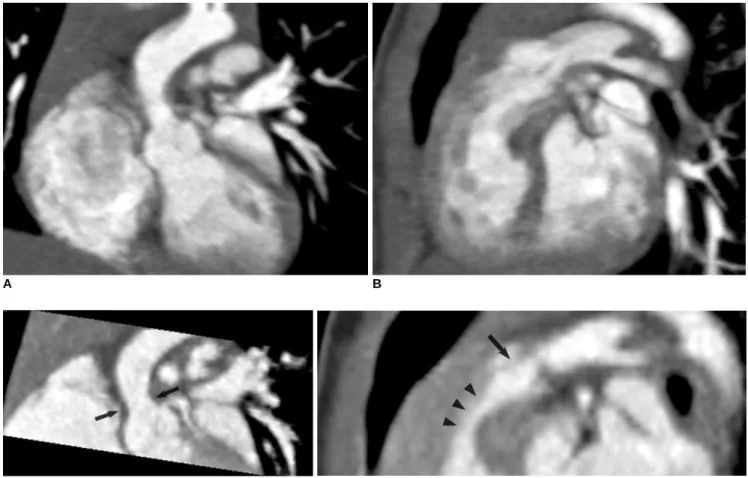 Fig. 9. Combo CT scan comprised of non-ECG-synchronized spiral scan with usual scan range (A, B) and prospective ECG-triggered sequential scan with narrow scan range confined to conotruncal area of heart (C, D) in 9-months-old boy with Williams syndrome.