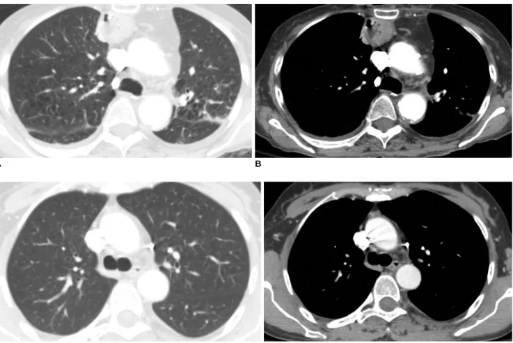 Fig. 3. 2.5 mm thick transverse chest CT performed by weight-adapted automatic exposure control technique in lung (A) and mediastinal (B) windows in 76-year-old female (weight 43 kg, objective noise 8.1, and CTDIvol 12.8 mGy)