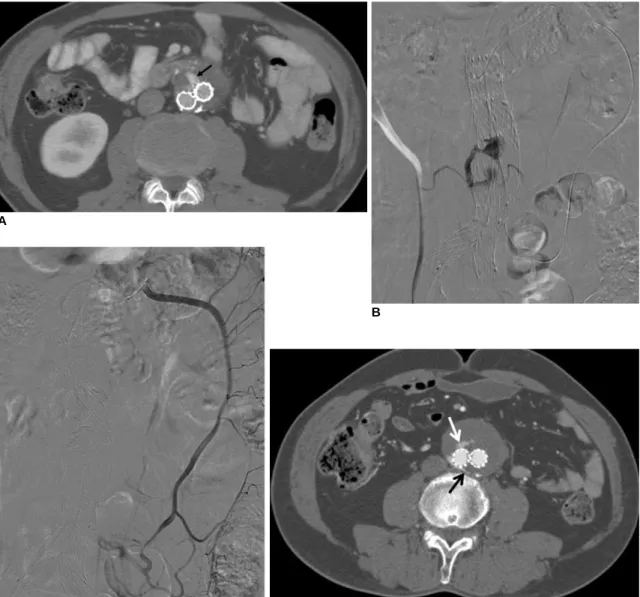 Fig. 3. Steps for endoleak repair via transabdominal approach with type ll endoleak, 64-year-old patient with type ll endoleak (No