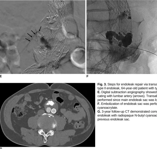 Fig. 3. Steps for endoleak repair via transabdominal approach with type ll endoleak, 64-year-old patient with type ll endoleak (No