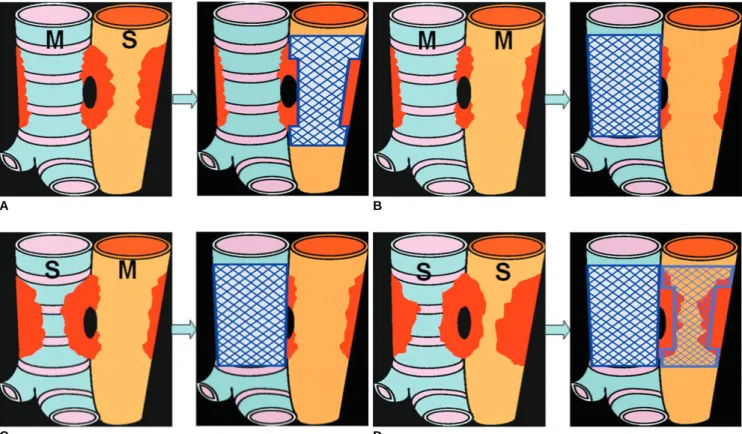 Fig. 3. Determination of stenting area in various types of esophagorespiratory fistula