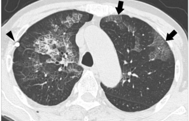 Fig. 3. 72-year-old man with bilateral re-expansion pulmonary edema. High-resolution CT taken seven hours after thoracentesis for right pneumothorax reveals mixed ground-glass opacity and minimal consolidation combined with intralobular reticulations and i