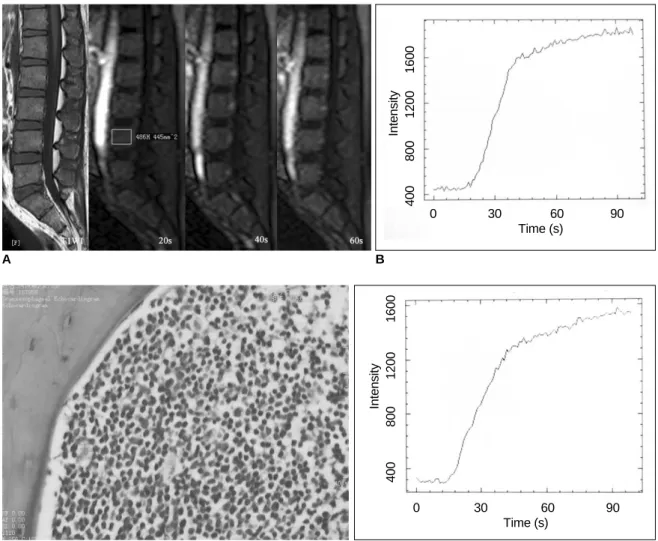 Fig. 1. 25-year-old man with acute lymphoblastic leukemia.