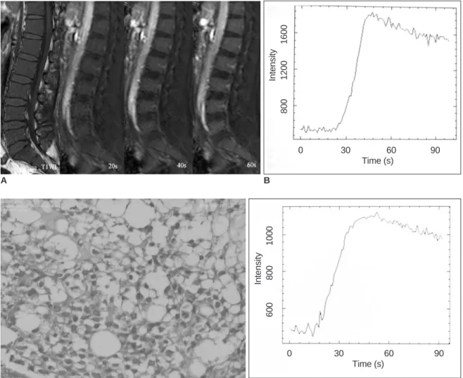 Fig. 2. 50-year-old patient with acute myeloid leukemia. 