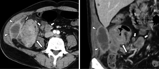 Fig. 5. 65-year-old man with adenocarcinoma of ascending colon.