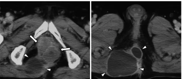 Fig. 8. 48-year-old woman with perforated mucinous carcinoma of appendix.