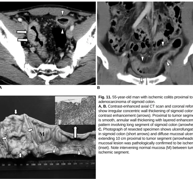 Fig. 11. 55-year-old man with ischemic colitis proximal to adenocarcinoma of sigmoid colon.