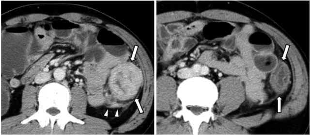 Fig. 12. 41-year-old man with adenocarcinoma of descending colon that was accompanied by distal segment of wall edema.