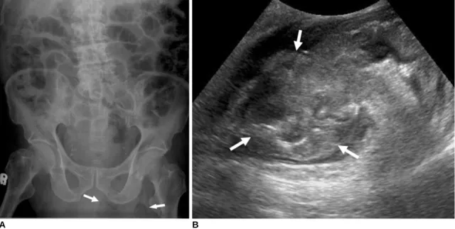Fig. 1. Colonic perforation within irreducible inguinal hernia.