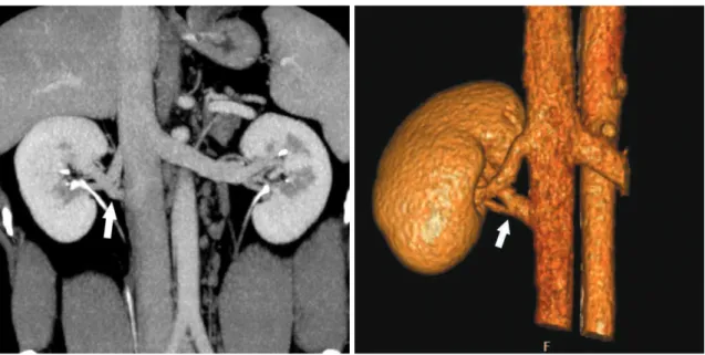 Fig. 8. Supernumerary right renal vein in 30-year-old male voluntary kidney donor. Curved coronal maximum intensity projection  (A) and anterior oblique volume rendered (B) images show two right renal veins crossing each other and draining into inferior ve