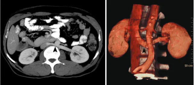 Fig. 13. Single retroaortic renal vein in 52-year-old female who presented with lower end biliary stricture