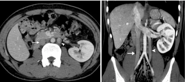 Fig. 15. Late venous confluence of left renal vein in 27-year-old male voluntary kidney donor