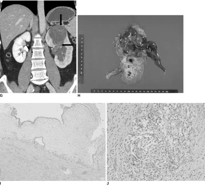 Fig. 1. Imaging findings are presented for 41-year-old woman with cystic embryonal sarcoma.