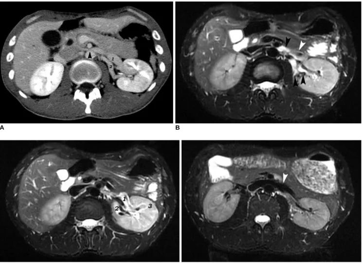 Fig. 1. Nutcracker syndrome in 24-year-old man. 