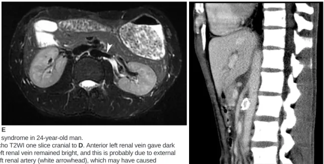 Fig. 1. Nutcracker syndrome in 24-year-old man. 