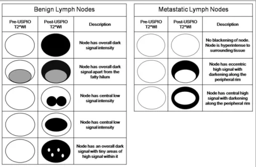 Fig. 2. Patterns of ultrasmall superpara- superpara-magnetic iron oxide (USPIO) uptake in benign and malignant lymph nodes on contrast-enhanced MRI of Lymph nodes, and respective interpretations of these patterns