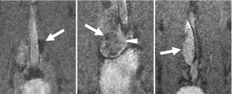 Fig. 3. Benign and metastatic lymph nodes on ultrasmall superparamagnetic iron oxide (MION [monocrystalline iron oxide nanoparticle]- nanoparticle]-47)-enhanced MR imaging in three rabbit VX2 tumor models