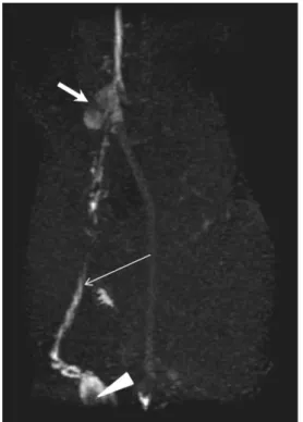 Fig. 5. Oblique coronal maximum intensity projection image from T1-weighted 3D gradient-echo MRI sequence obtained 60 minutes after interstitial administration of 5 μ mol/kg gadofluorine M in VX2 tumor rabbit model