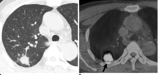 Fig. 1. Pulmonary cryptococcosis with clustered nodular pattern in 53-year-old man who had hepatocellular carcinoma (patient 11 in Tables 1, 2).