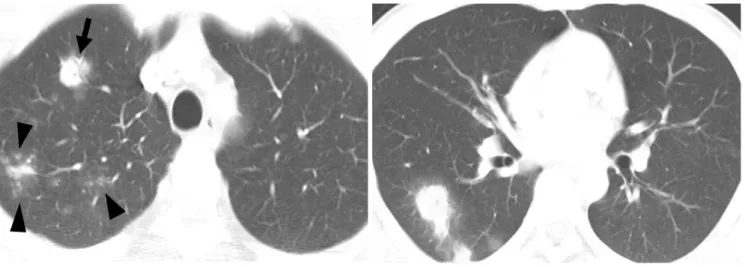Fig. 4. Cryptococcosis of bronchopneumonic pattern in 72-year-old woman who has underlying breast cancer (patient 22 in Tables 1, 2).