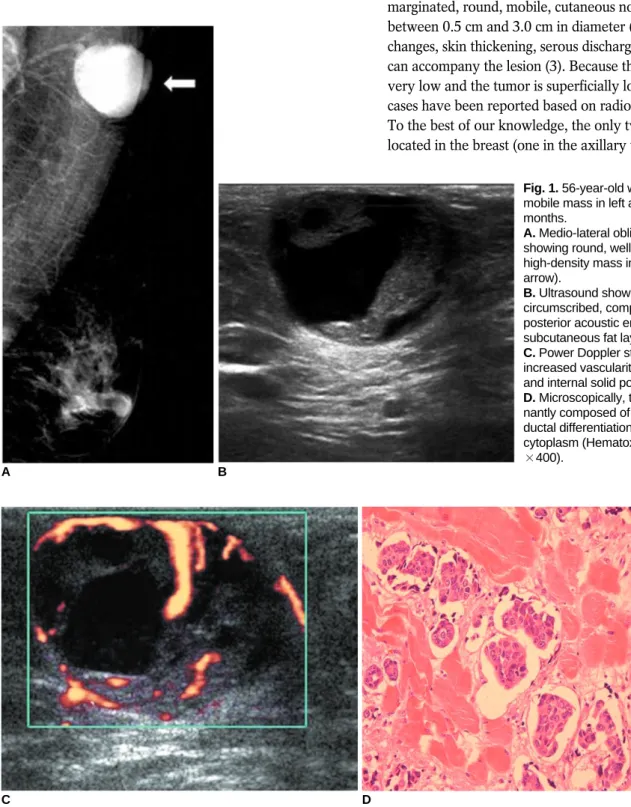 Fig. 1. 56-year-old woman with soft, mobile mass in left axillary tail for six months.