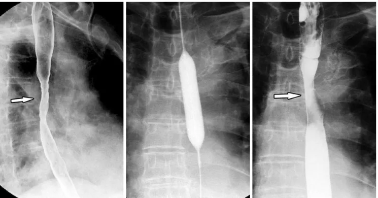 Fig. 1. Radiation-induced esophageal stricture. 