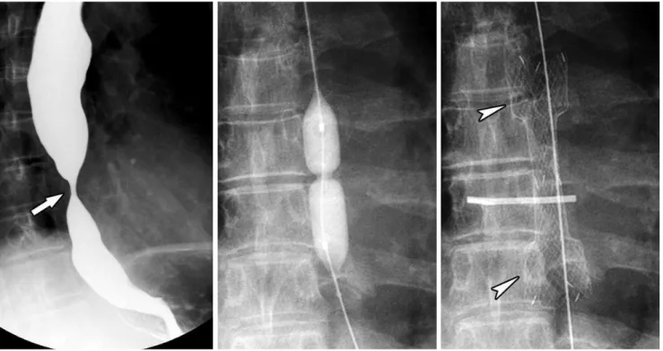 Fig. 2. Corrosive esophageal stricture. 