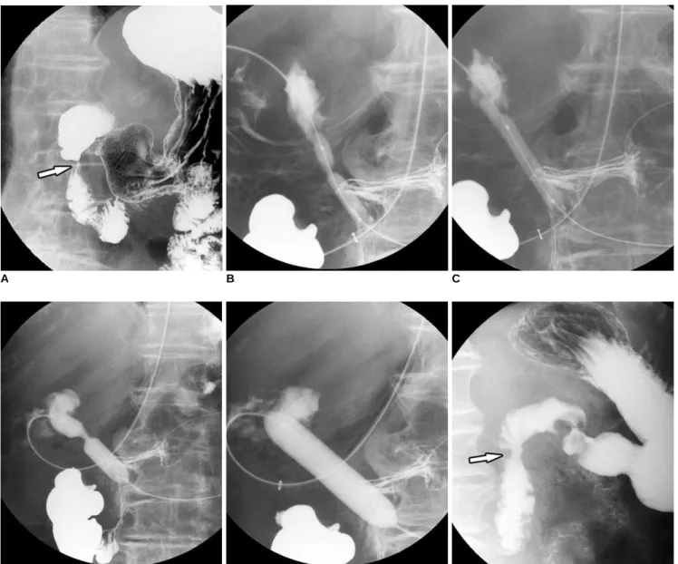 Fig. 3. Peptic ulcer-induced duodenal stricture.