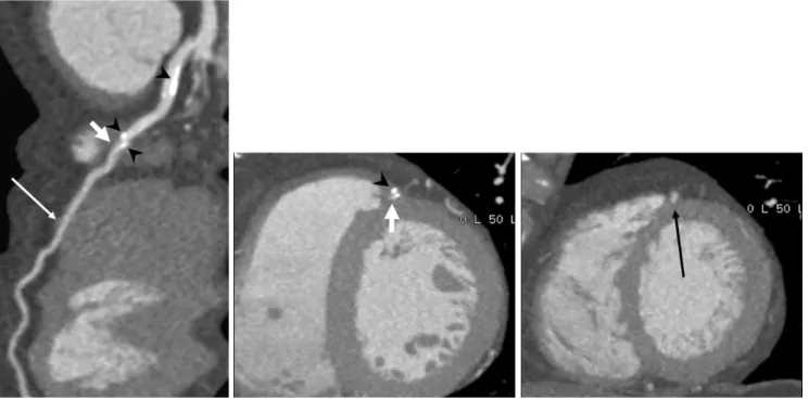 Fig. 3. 57-year-old man presented with angina.