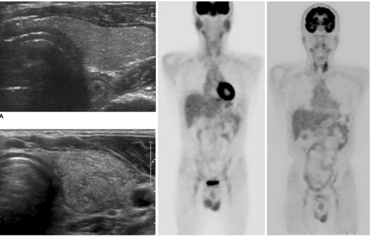 Fig. 1. Diffuse sclerosing variant of papillary thyroid carcinoma in 48-year-old man.