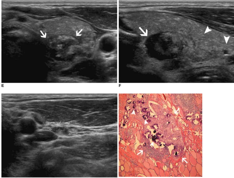 Fig. 1. Diffuse sclerosing variant of papillary thyroid carcinoma in 48-year-old man.