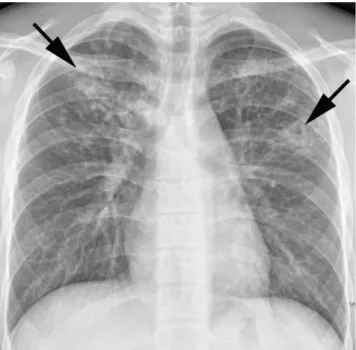 Table 1.  Abnormal Radiographic Findings in Primary Pulmonary Tuberculosis in Previously Healthy Adolescent Patients (n = 55)  Variables Number Small nodules (D < 10 mm) 53 (96%) Large nodules (10 mm ≤ D < 30 mm) 28 (51%) Cavity 25 (45%) Consolidatio