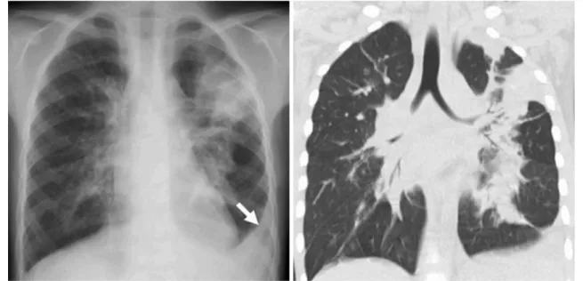 Fig. 3. 6-year-old boy with laboratory-confirmed novel influenza A (H1N1). (Case No. 5)