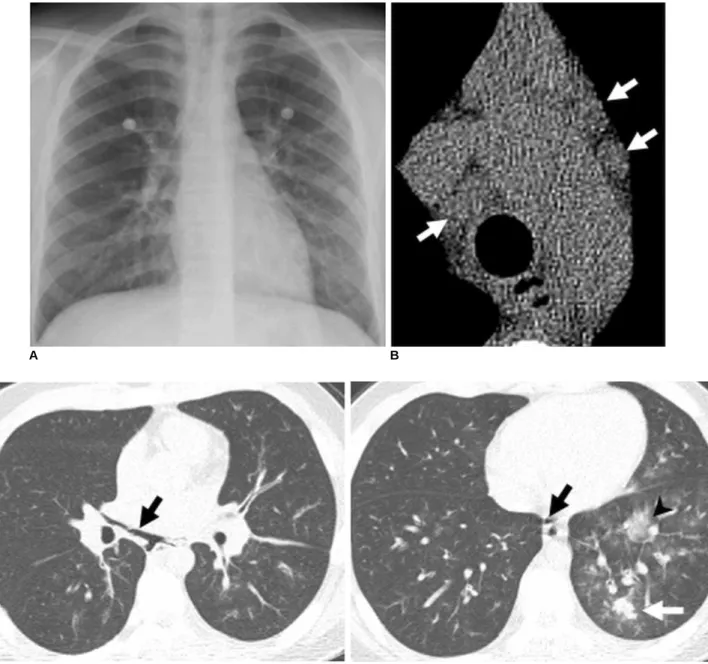 Fig. 4. 16-year-old boy with laboratory-confirmed novel influenza A (H1N1). (Case No. 2)