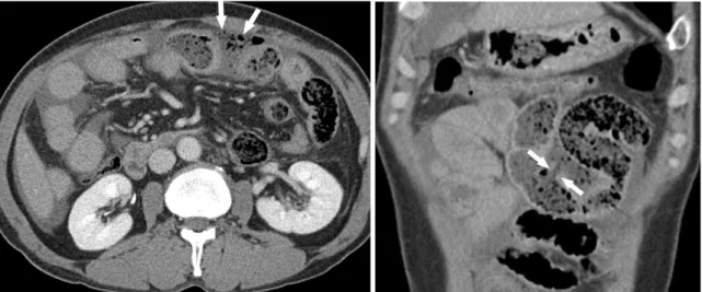 Fig. 1. 46-year-old man with traumatic small bowel perforation.  