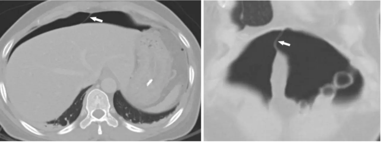 Fig. 7. 41-year-old woman with perforation of gastric body that complicates endoscopic submucosal dissection