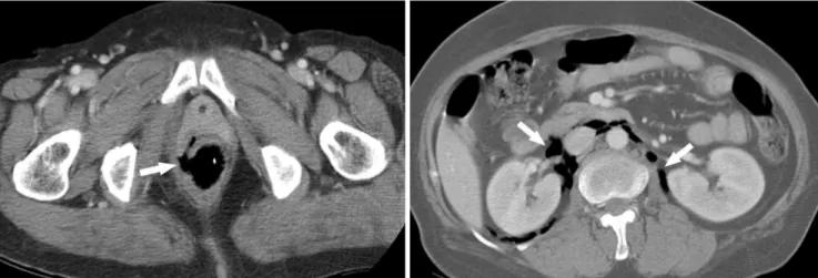 Fig. 13. 81-year-old man with spontaneous perforation of sigmoid colon.